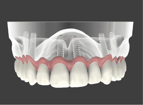 Dental Implant Kingwood, TX