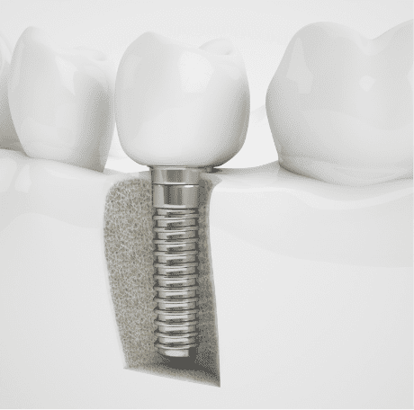 Kingwood, TX Implants